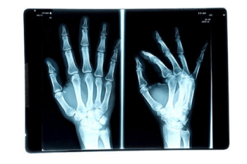 X-ray of hands