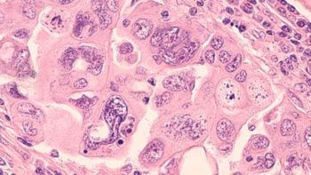 High power photomicrograph of a serous papillary carcinoma of the ovary