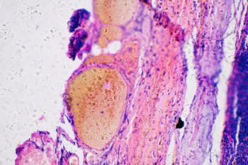 Melanoma cancer cells of human under microscope