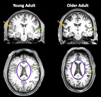 Brain images from a 35-year-old and an 85-year-old. 