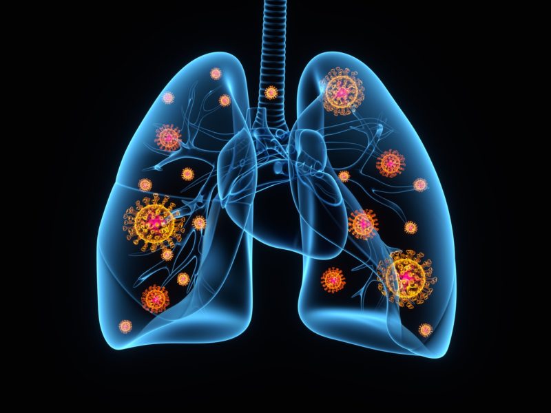 artist's rendering representing a covid-19 virus infection in human lungs