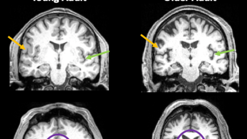 a grid of four brain scans