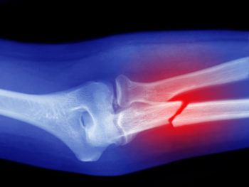 x-ray image of a broken arm
