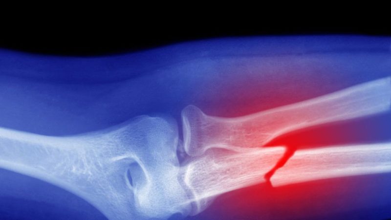 x-ray image of a broken arm