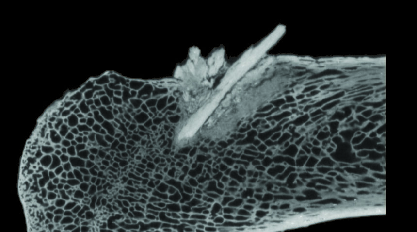 CT scan of bone point fragments embedded in the rib