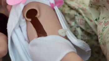 A side view of the device displays a porous polyurethane cuff outside the body to improve healing time and prevent fluid leakage when a catheter is inserted into a baby’s abdomen.