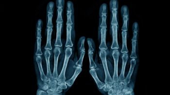 a photo of an X-ray of a pair of hands.