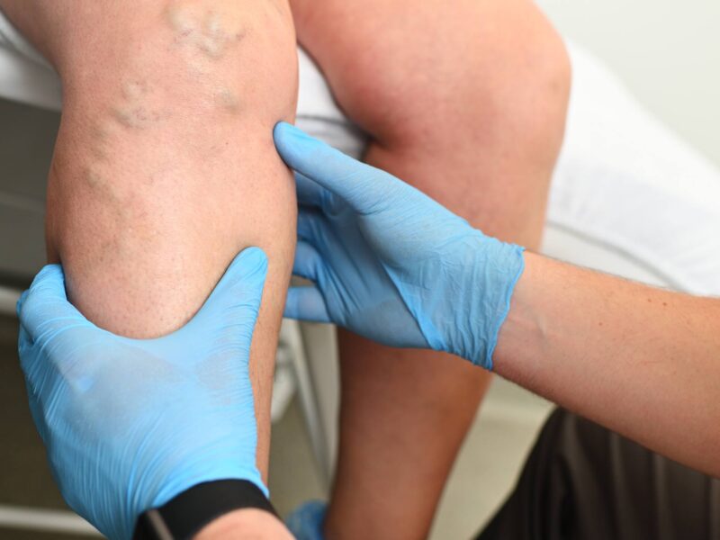 a phlebologist examines a patient with varicose veins on his leg. phlebology - study of venous pathologies of the lower extremities