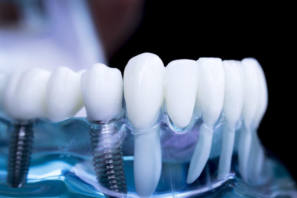 A close-up photo of a set of dentures.