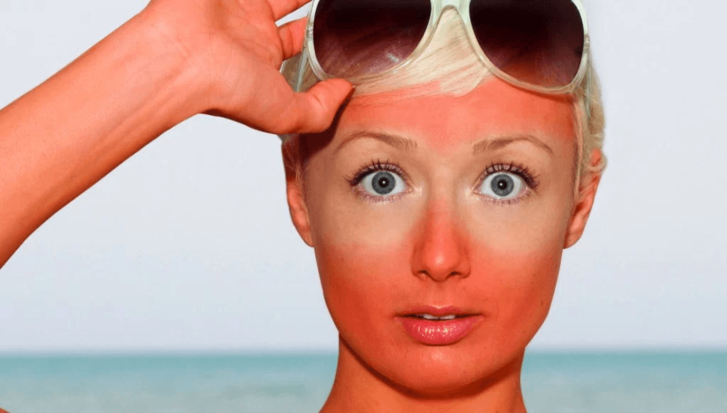 a sunburned woman lifts her goggles