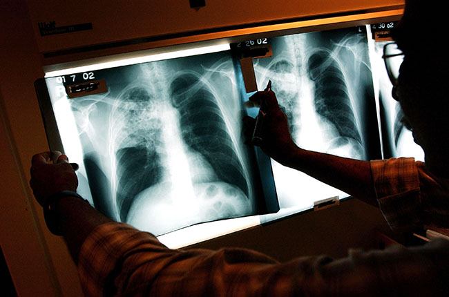 A doctor examines the x-rays of a tuberculosis (TB) patient at a TB clinic Novmeber 27, 2002 in Brooklyn, New York. Healthcare workers around the country oversee patients in a program called Directly Observed Therapy (DOT) that ensures carriers of the tuberculosis bacteria take their medication. Tuberculosis is a contagious disease of the lungs that is spread through the air and kills around 2 million people annually, mainly in third world countries. It is relatively easy and affordable to treat, with a six-month series of drugs costing around 10 dollars. While the number of TB cases in the United States has dropped in recent years, the disease is still particularly strong among the foreign-born, the homeless and impoverished contributing to the deaths of thousands of Americans yearly. As of 2000, over 16,000 Americans have contracted tuberculosis. (Photo by Spencer Platt/Getty Images)